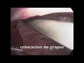 hernioplastia