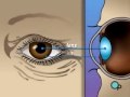 PreOp® Patient Education Cataract Small Incision Eye
