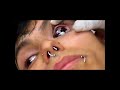 eyeball