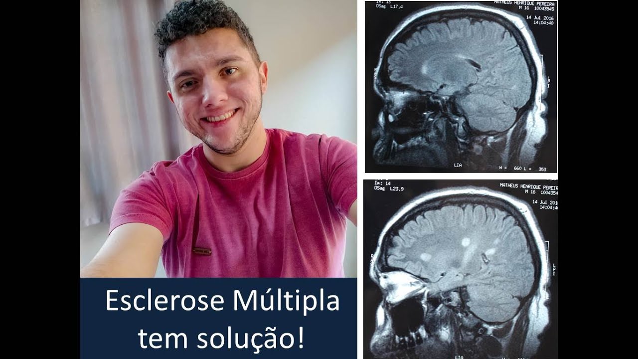 Matheus - Esclerose Múltipla - 3 anos de tratamento