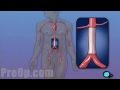 Abdominal Aortic Aneurysm - Open Repair Surgery - PreOp® Patient Education HD