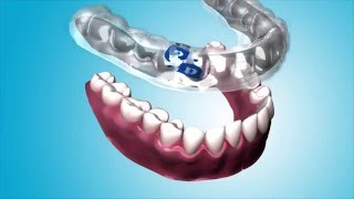What is Perio Protect?