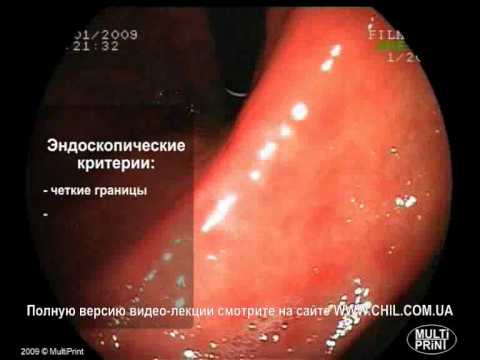 Папулезная гастропатия что это такое как лечить Папулезная гастропатия что это такое как лечить