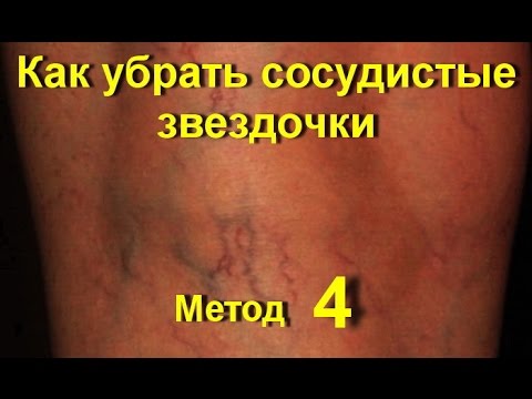 Убрать сосудистые звёздочки на ногах в домашних условиях Убрать сосудистые звёздочки на ногах в домашних условиях
