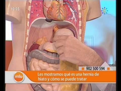 Hernia de Hiato Médicos Mira la Vida - YouTube