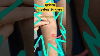 Normal Knee Vs Synovitis Kneeघटन म बड सजन क करण ?