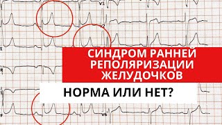 Синдром Ранней Реполяризации Желудочков. Норма Или Патология?!