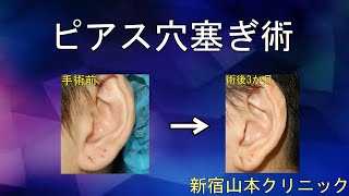 ピアス穴ふさぎ(ボディピアス) 山本クリニック