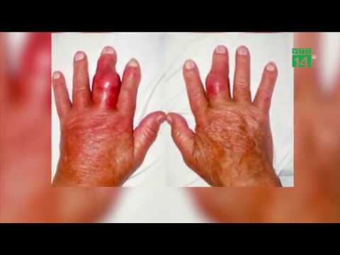 VTC14 | Vì sao bệnh gout ngày càng trẻ hóa và gia tăng ở Việt Nam?