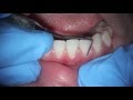 treating anterior puffy gums