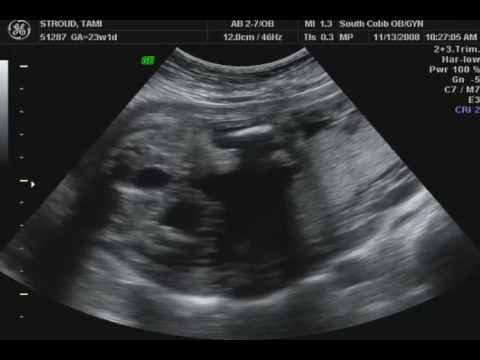 3D ultrasound of our twin girls at 23 weeks 4 days. 3d ultrasound pictures of twins. 3D ultrasound of our twin girls at 23 weeks 4 days.