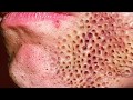 Trypophobia, Popping Pimples & Cysts or Warts!