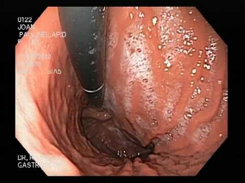 Endoscopy: Meet my stomach! - YouTube