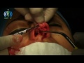 image Nose Surgery Operation Operasi Bedah Hidung