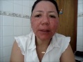 Minha experiência com laser Co2 Fracionado | Laser Co2 fracionado para tratamento da pele