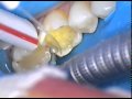DR. GERARD CUOMO - Replacing old dental fillings with cosmetic crowns. 1 of 4 Boca Raton, Florida