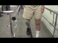 Man gets Chicago's first fitting for bionic ankles in Oak Park