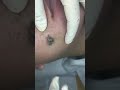 Extracción de un gran punto negro || Extraction of a large black point