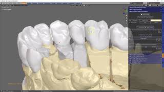 Making temporary crowns