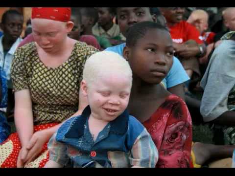 Through albino eyes. Through albino eyes. 11:30. Over the past two years at least 56 albino people in Burundi and Tanzania have been killed by hunters