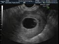 Ultrasound of Twins at 7 weeks