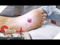Verrückt: Diesem Mädchen wächst eine Brustwarze unter dem Fuß | Klinik am Südring | SAT.1 TV