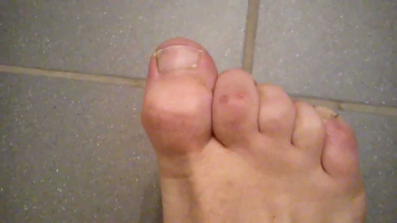 Hammer Toe