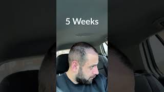Hair Transplant Process - Week by Week - 3 Months
