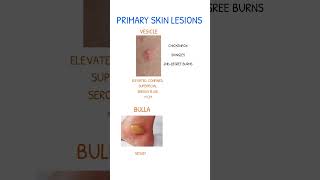 Skin Lesions Vesicle Vs Bulla