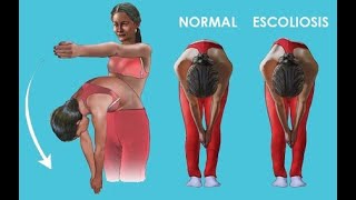 Prueba De Adams Para Detectar Escoliosis