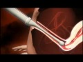 3D animation of how IVF works