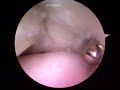 Hip arthroscopy Dr. Cascio 2/7: CAM lesion.mpg