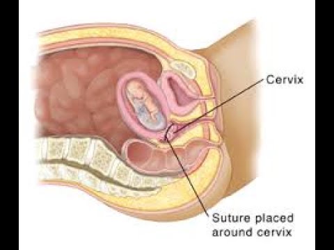 Prolapsed cervix photos