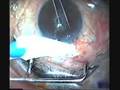 Cyanoacrylate Uses | RM. Cyanoacrylate Uses | RM.