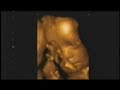 4D Ultrasound