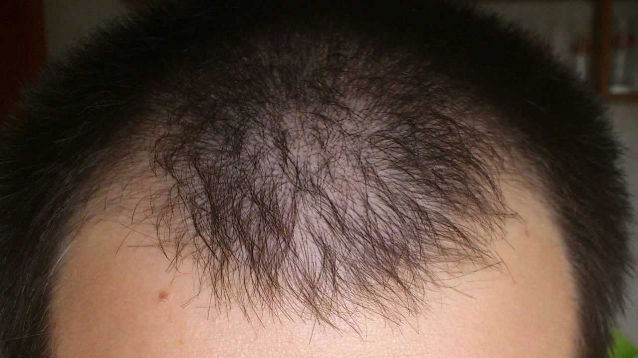 how long does it take for minoxidil to show results