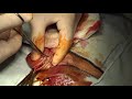 adult circumcision