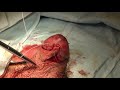 adult circumcision