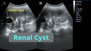 Renal Ultrasound Showing A Renal Cyst Lesion