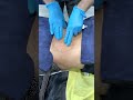 Fat Dissolving Injection to Belly