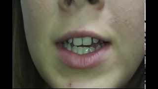 Vanessa's Labiaplasty Surgery Experience with Dr D at OcBody.com