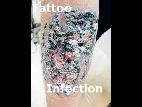 tattoo removal worst tattoo infection ive tattoo removal infection ...