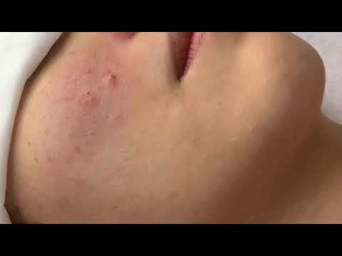 Hướng Dẫn Cách Lấy Nhân Mụn Không Bị Đau Sưng - Lớp Học Chăm Sóc Da