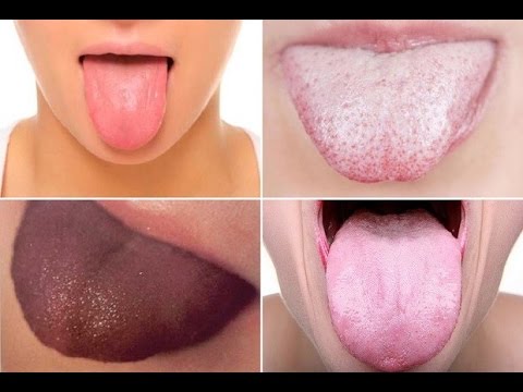 0 - Чорний язик у дитини: причини темного нальоту, що робити