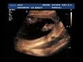 BABY ULTRASOUND ITS A GIRL! 22 WEEKS