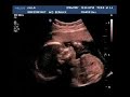 BABY ULTRASOUND ITS A GIRL! 22 WEEKS