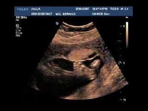 at 18 weeks can you find out the sex of the baby