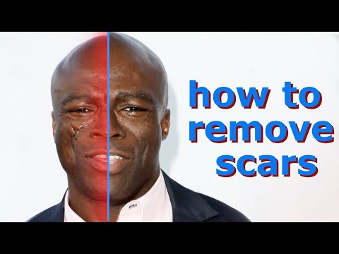 Seals facial scars