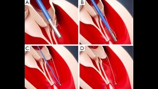 Transseptal chordal replacement: early experience