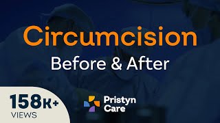 Before Vs After Laser Circision Surgery - For Free Consultation Call On 08065417725